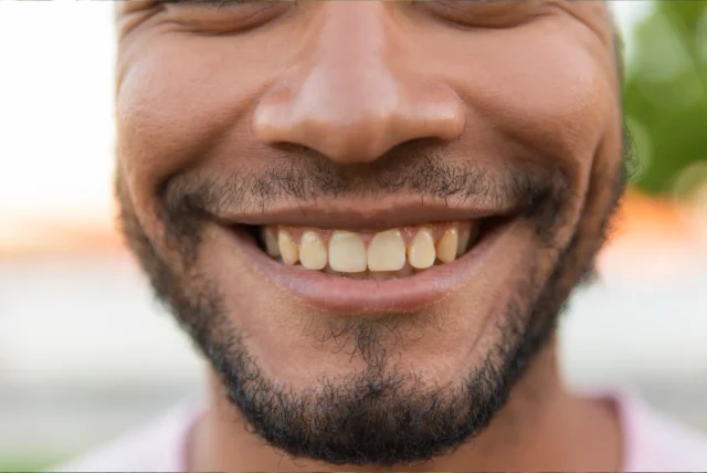 Brown teeth